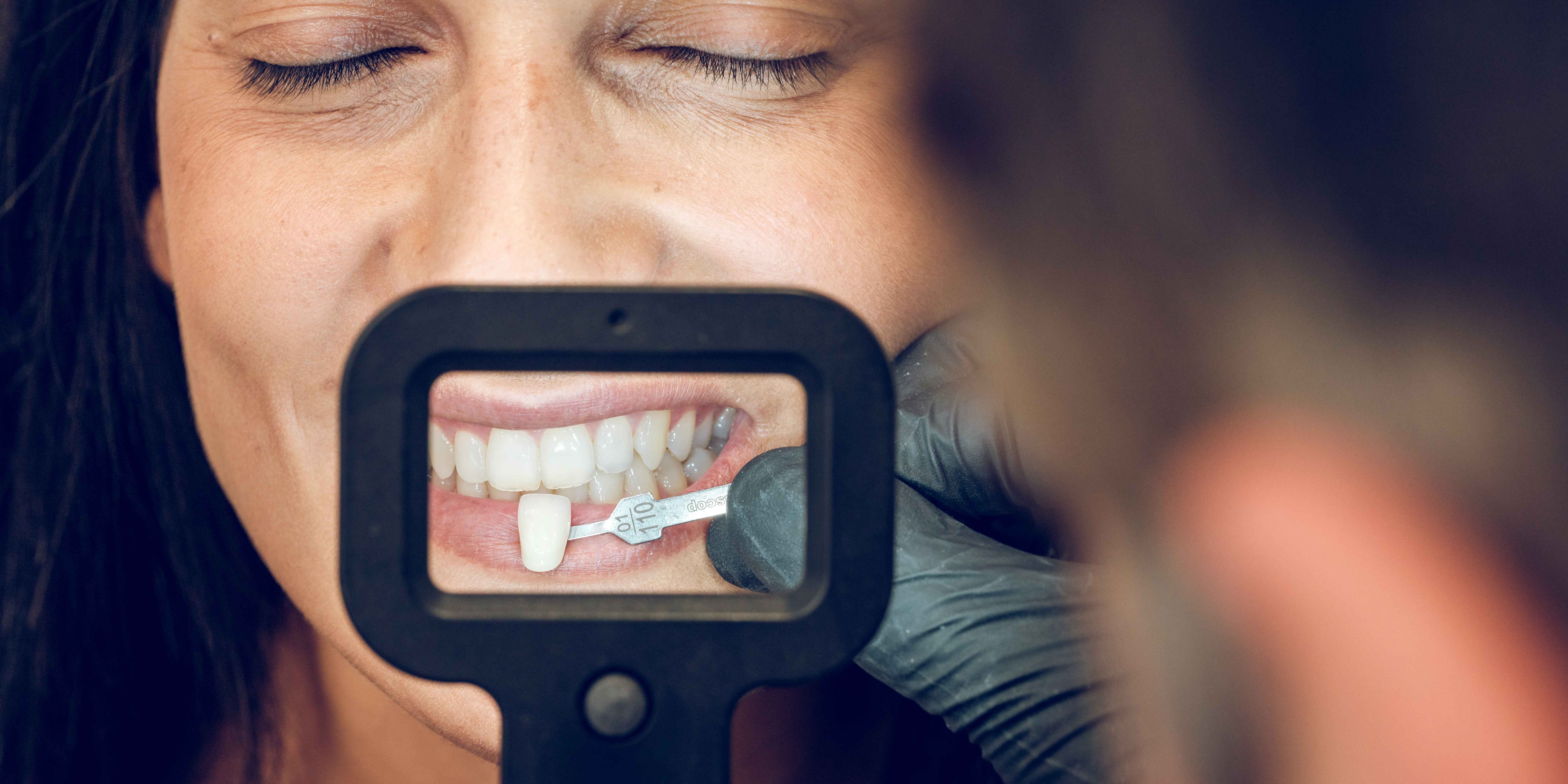 Porcelain Veneers: What to Expect Before, During, and After Treatment