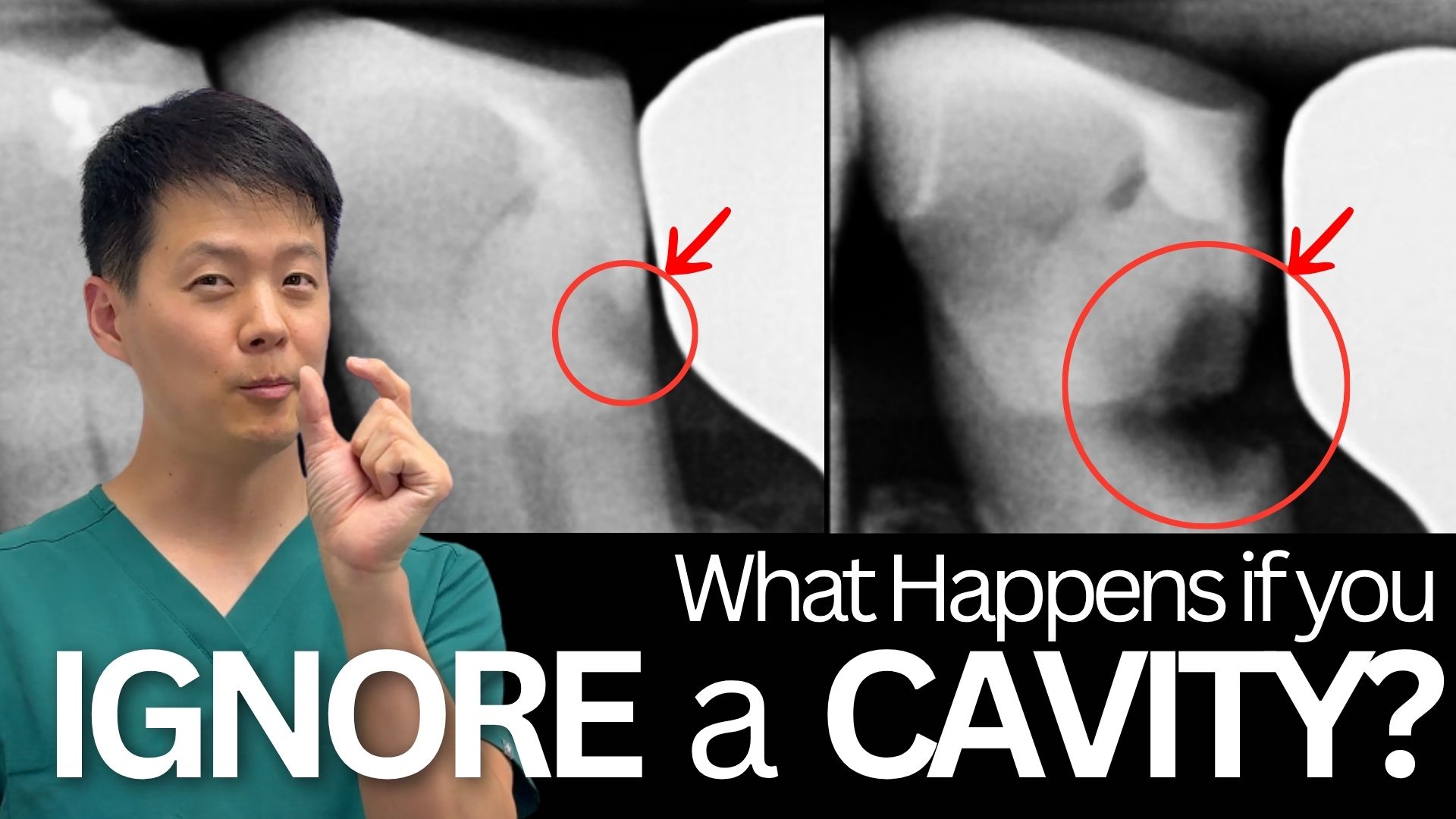 Video of Dr. John Ku explaining what happens if you ignore a cavity and treatment