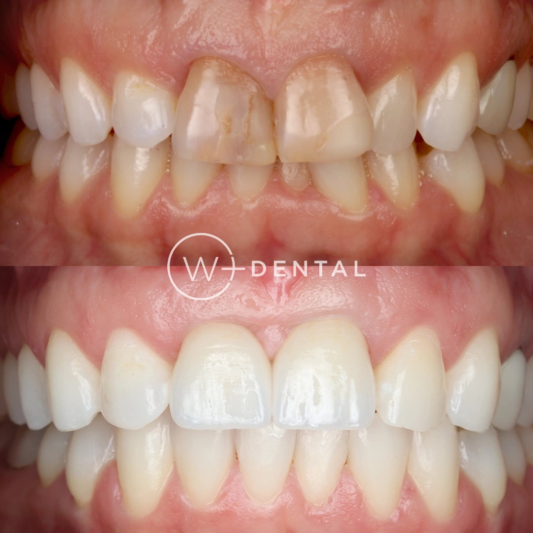 Before and after dental implants at W Plus Dental – patient's smile transformation showing missing tooth replaced with natural-looking implant, Washington DC