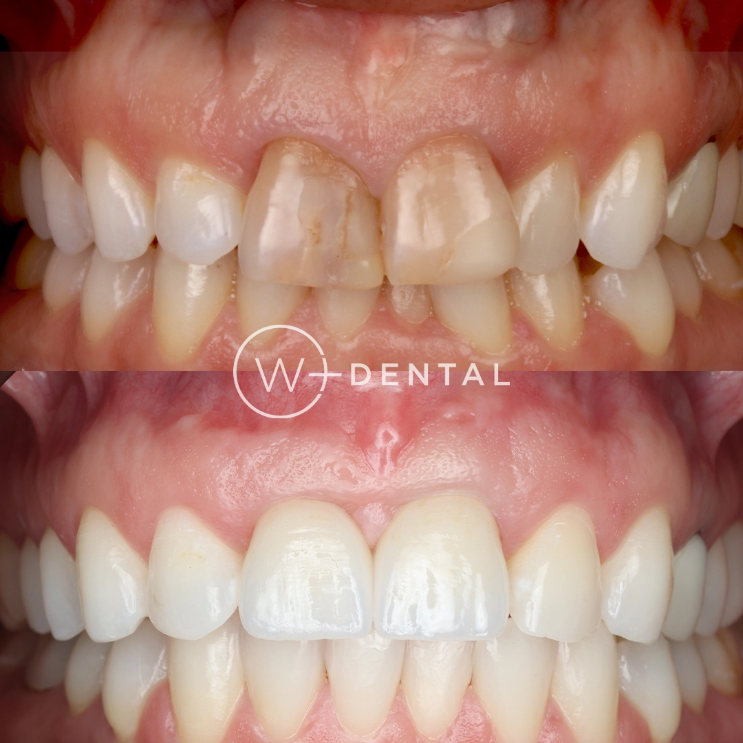 Before and after dental implants at W Plus Dental – patient's smile transformation showing missing tooth replaced with natural-looking implant, Washington DC