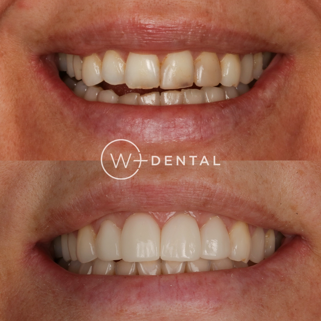 Before and after photo showing four porcelain crowns placed on the upper front teeth at W Plus Dental in Washington, DC.