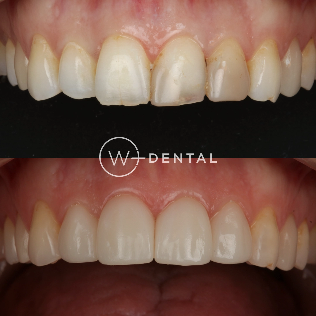 Before and after photo showing four porcelain crowns placed on the upper front teeth at W Plus Dental in Washington, DC.