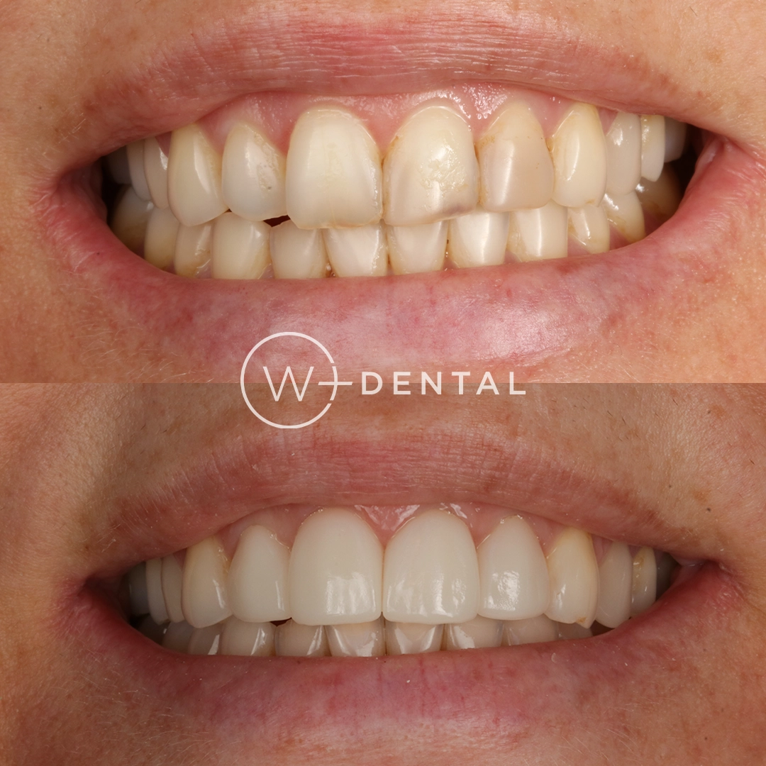 Before and after photo showing four porcelain crowns placed on the upper front teeth at W Plus Dental in Washington, DC.