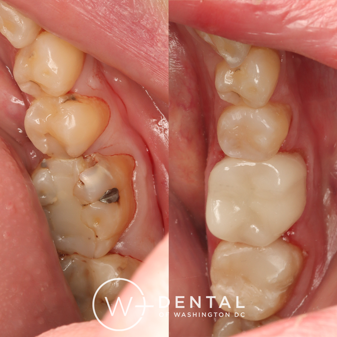 before and after dental bonding for a chipped tooth