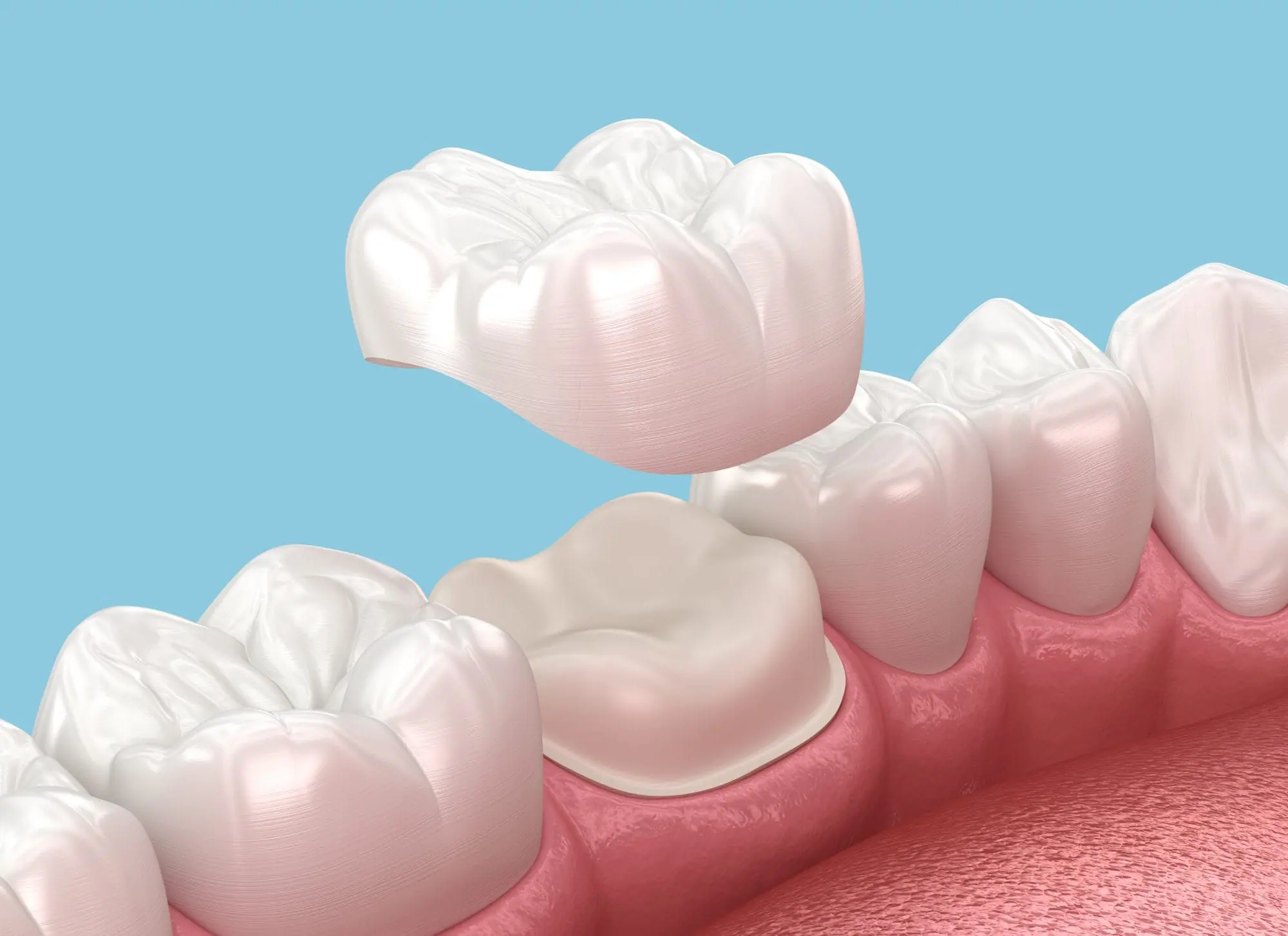 Dental filling treatment in Washington DC at W Plus Dental