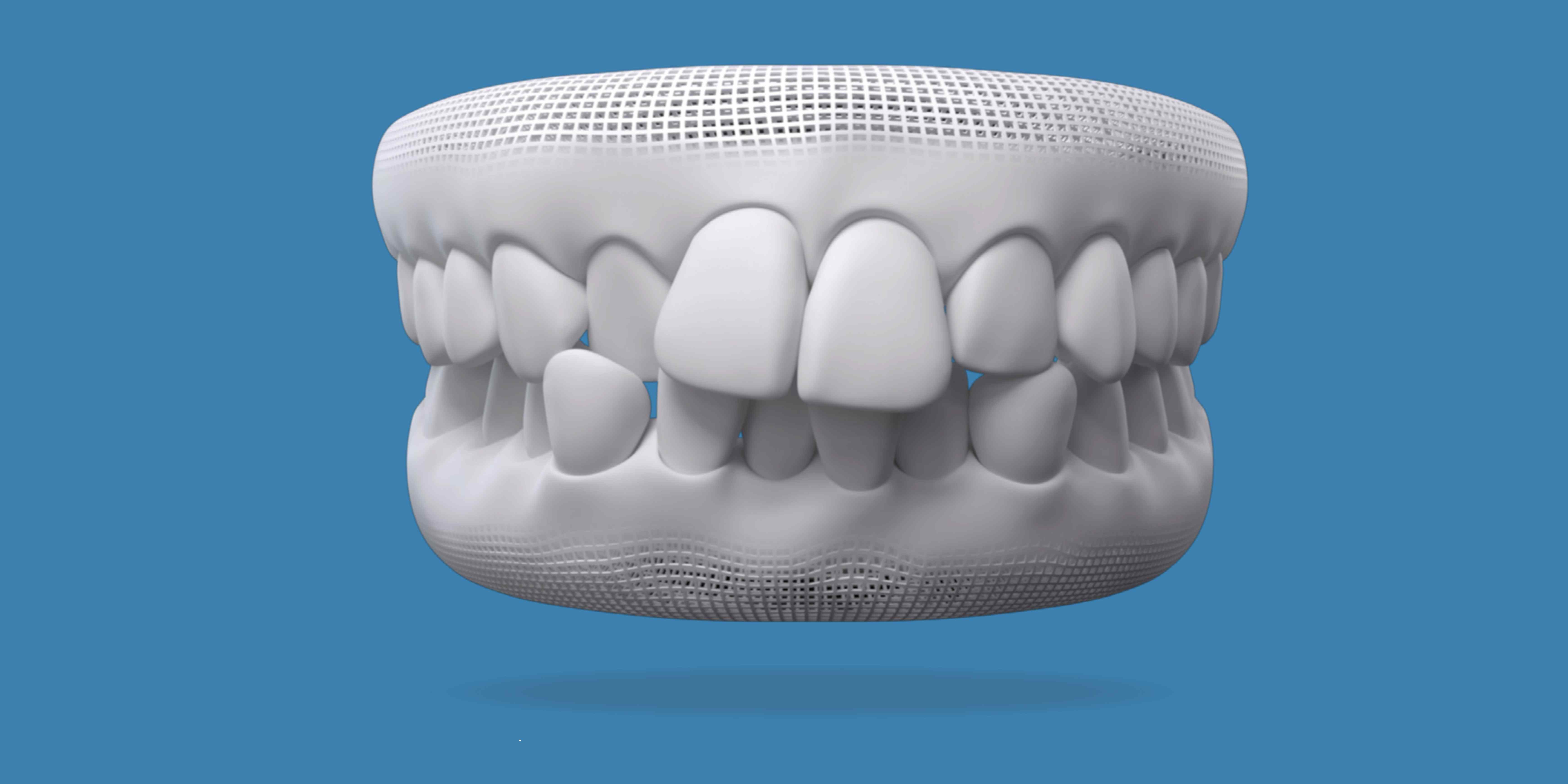 Invisalign for crowded teeth Washington, DC | W Plus Dental