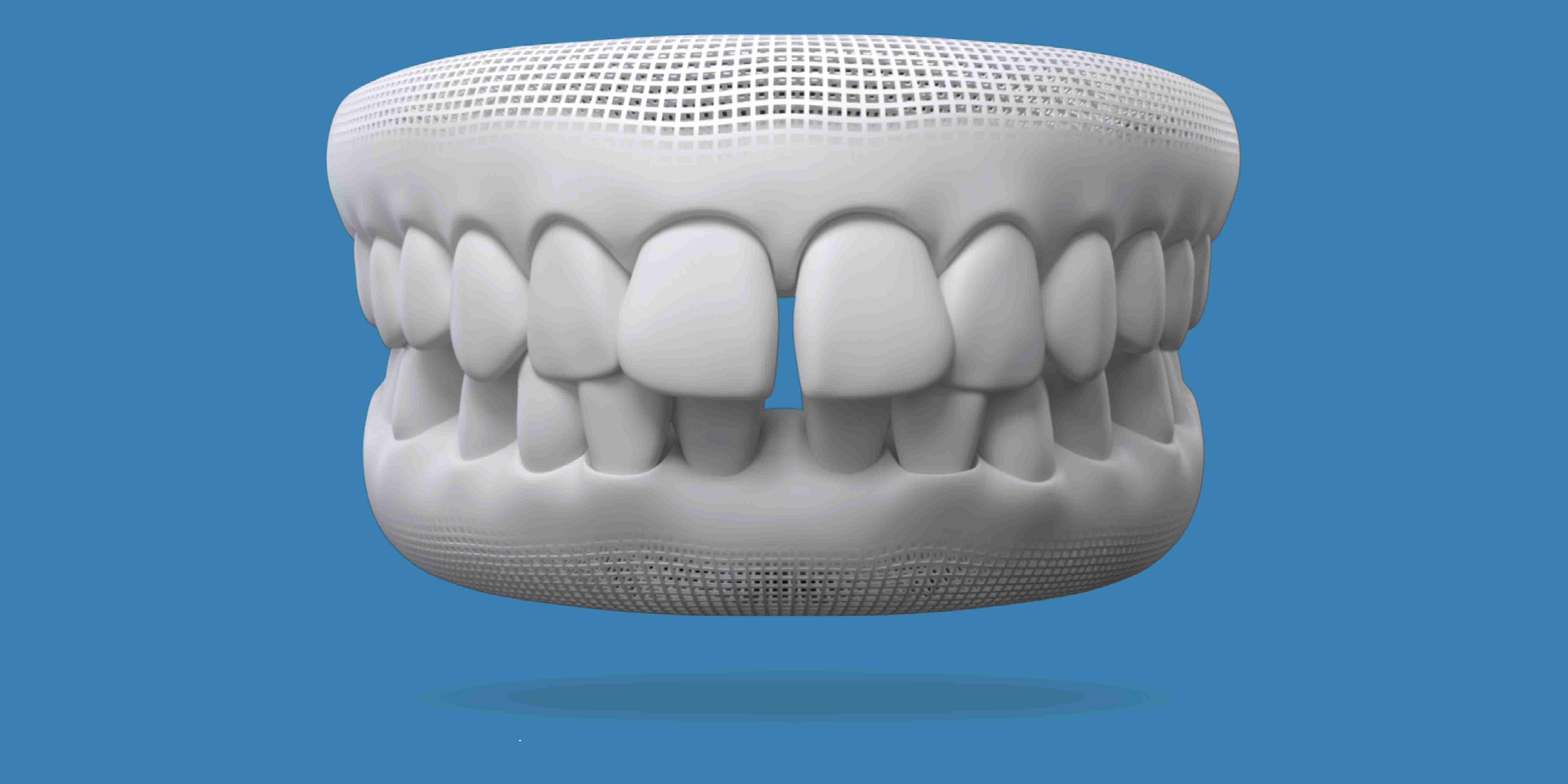 Invisalign for gapped teeth at W Plus Dental in Washington DC