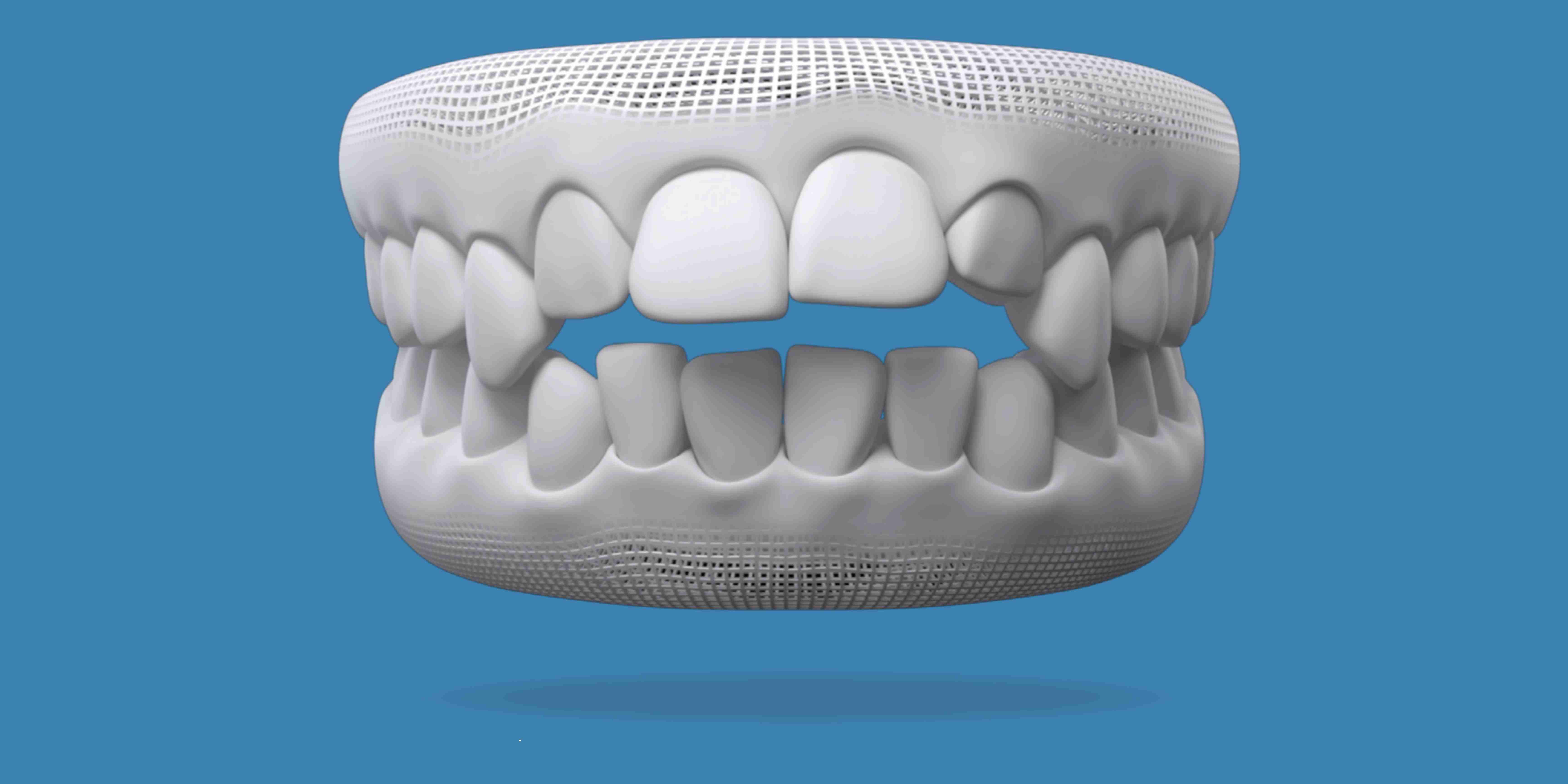 Invisalign for open bite Washington, DC | W Plus Dental