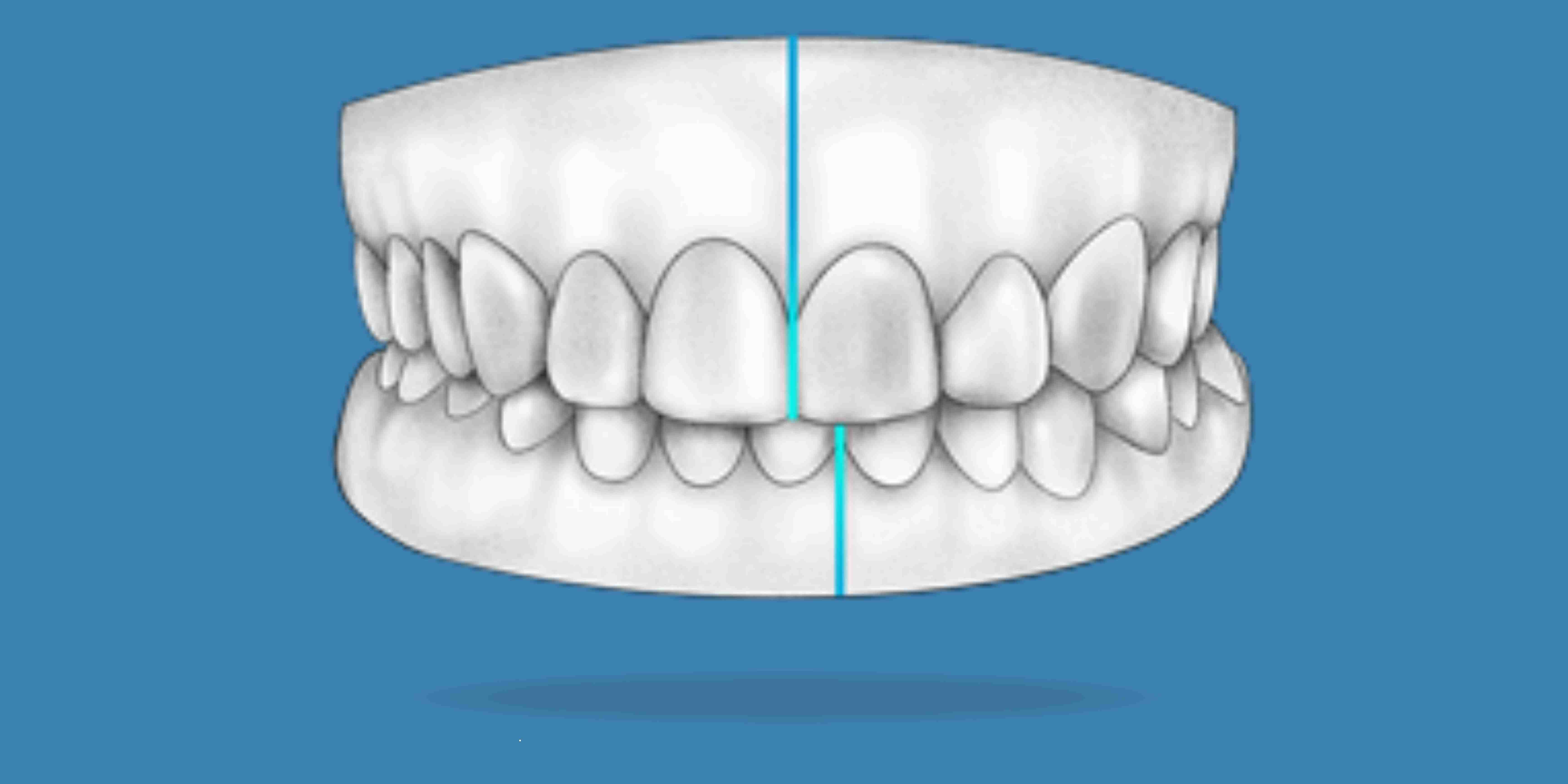 Invisalign for crooked teeth Washington DC