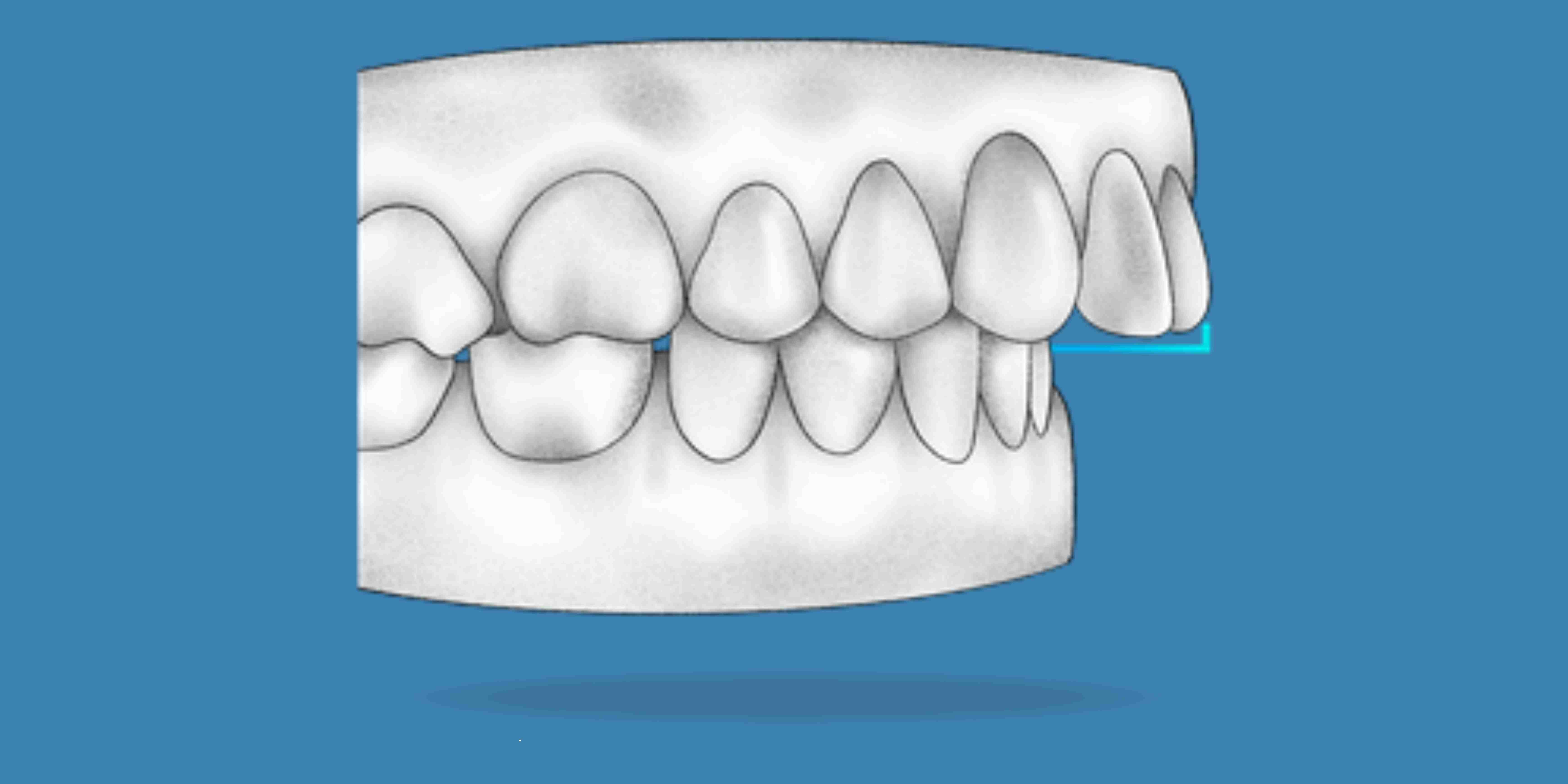 Invisalign for overjet Washington DC