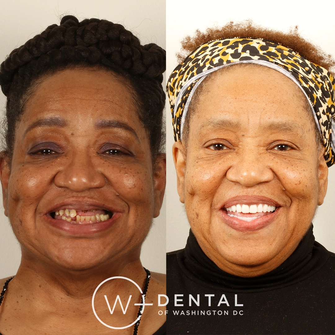 Before and after a smile makeover with All-on-X dental implants at W Plus Dental – full arch tooth replacement transforming missing and failing teeth to a complete, permanent smile, Washington DC