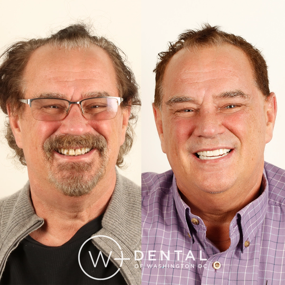 Before and after a smile makeover with All-on-X dental implants at W Plus Dental – full arch tooth replacement transforming missing and failing teeth to a complete, permanent smile, Washington DC