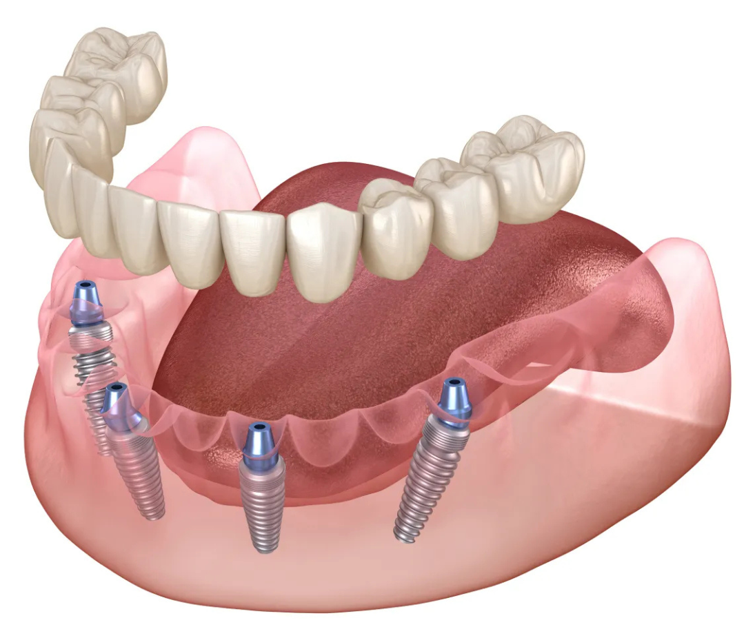 All-on-X Dental Implants Washington, DC | W Plus Dental