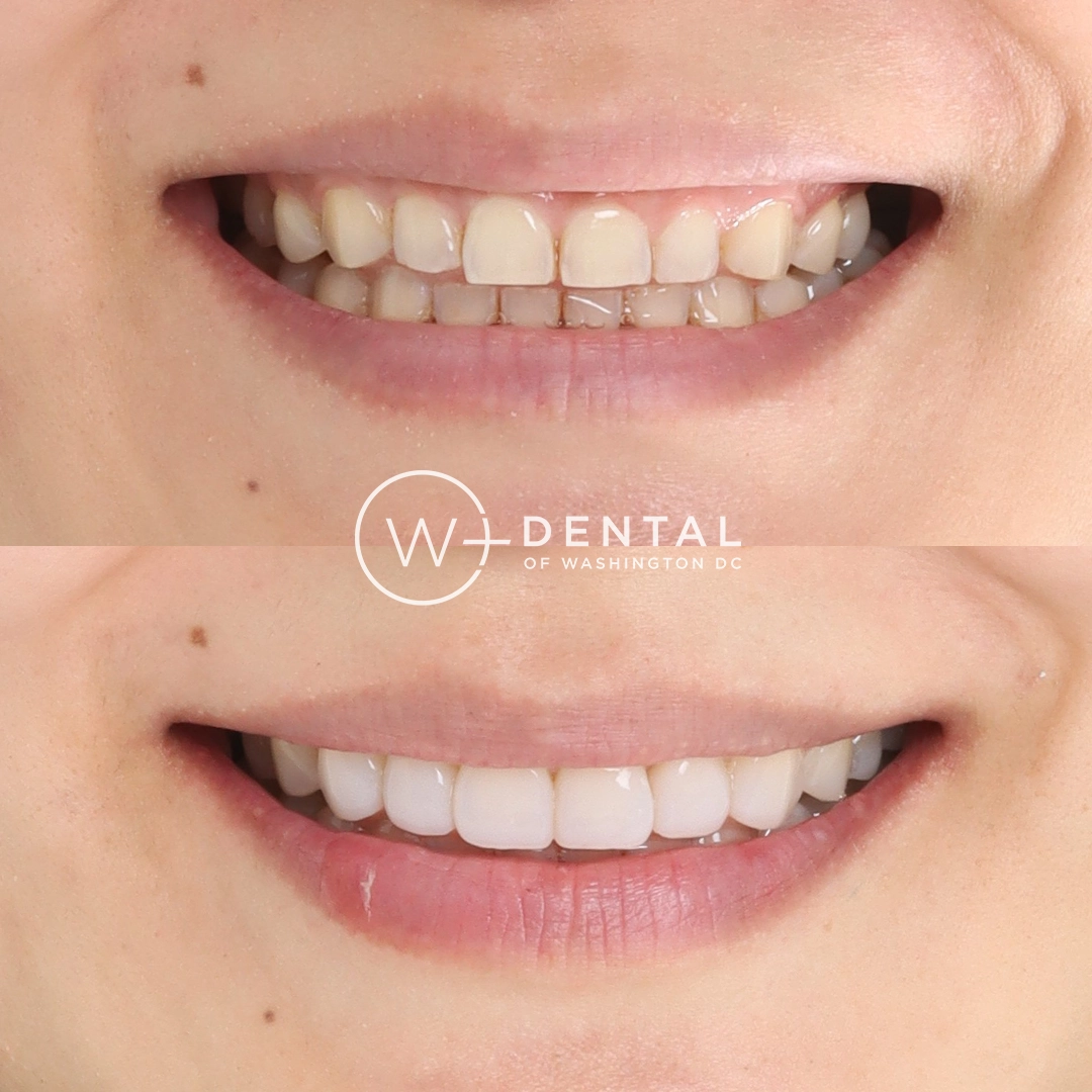 Before and after smile makeover with porcelain veneers at W Plus Dental – full smile transformation correcting gaps, discoloration, and uneven teeth, Washington DC