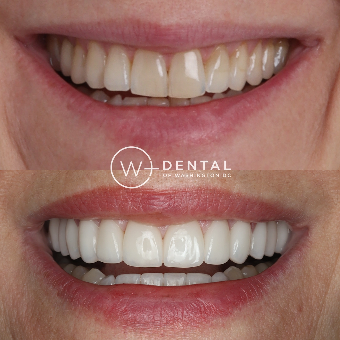 Before and after smile makeover with porcelain veneers at W Plus Dental – full smile transformation correcting gaps, discoloration, and uneven teeth, Washington DC