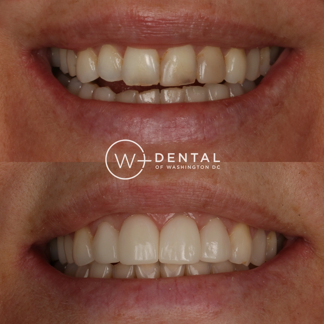 Before and after smile makeover with porcelain veneers at W Plus Dental – full smile transformation correcting gaps, discoloration, and uneven teeth, Washington DC