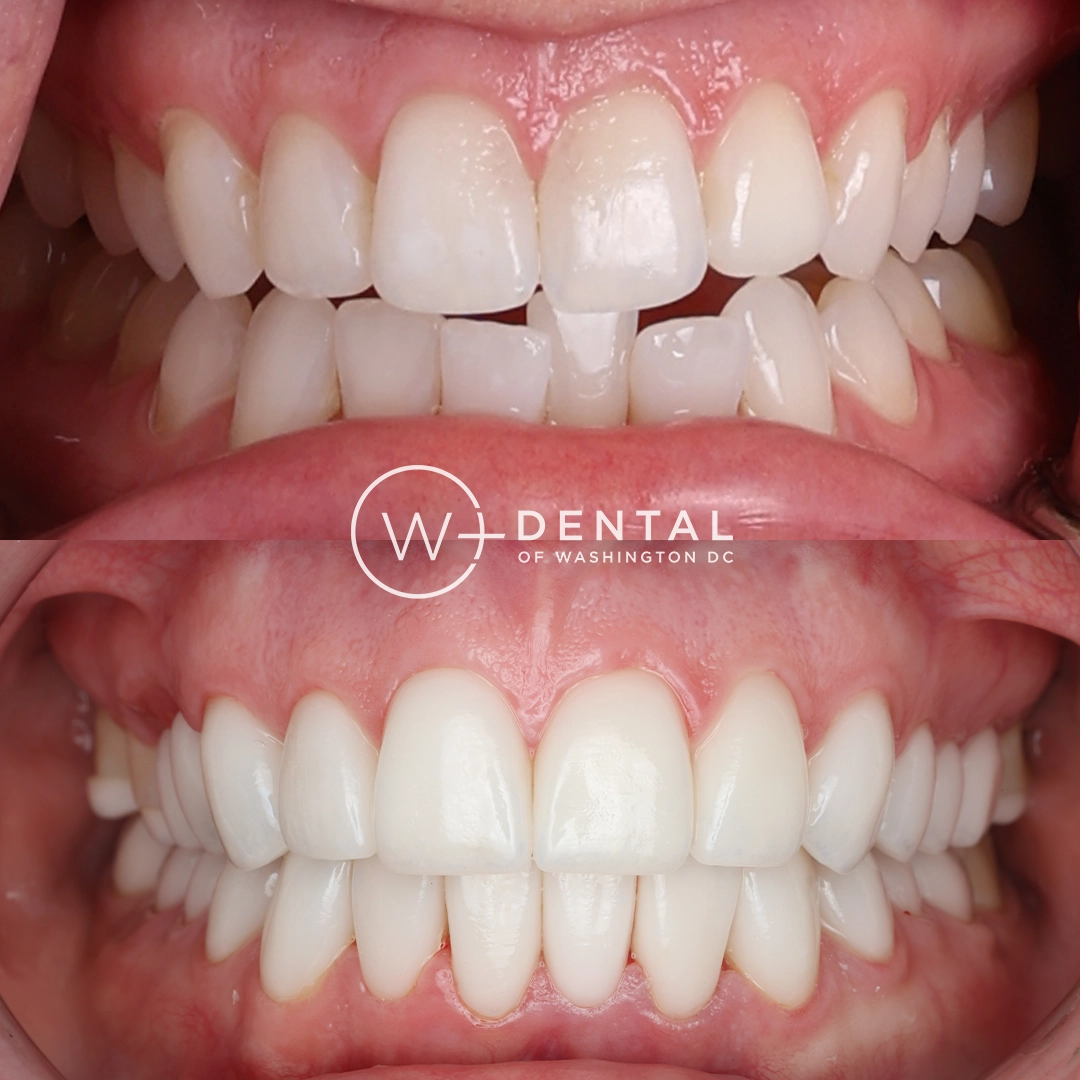 Before and after smile makeover with porcelain veneers at W Plus Dental – full smile transformation correcting gaps, discoloration, and uneven teeth, Washington DC