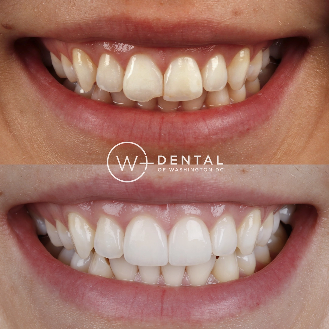 Before and after smile makeover with porcelain veneers at W Plus Dental – full smile transformation correcting gaps, discoloration, and uneven teeth, Washington DC