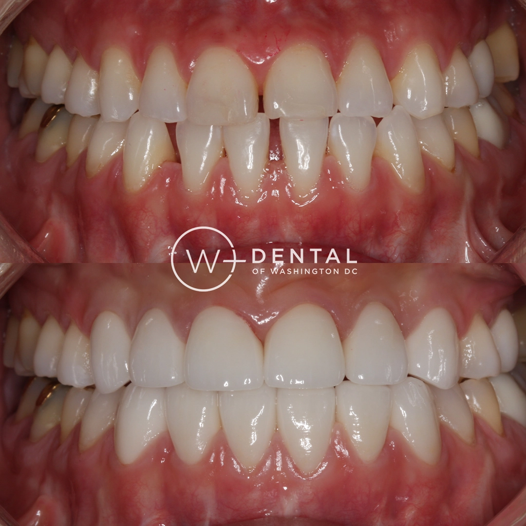 Before and after smile makeover with porcelain veneers at W Plus Dental – full smile transformation correcting gaps, discoloration, and uneven teeth, Washington DC