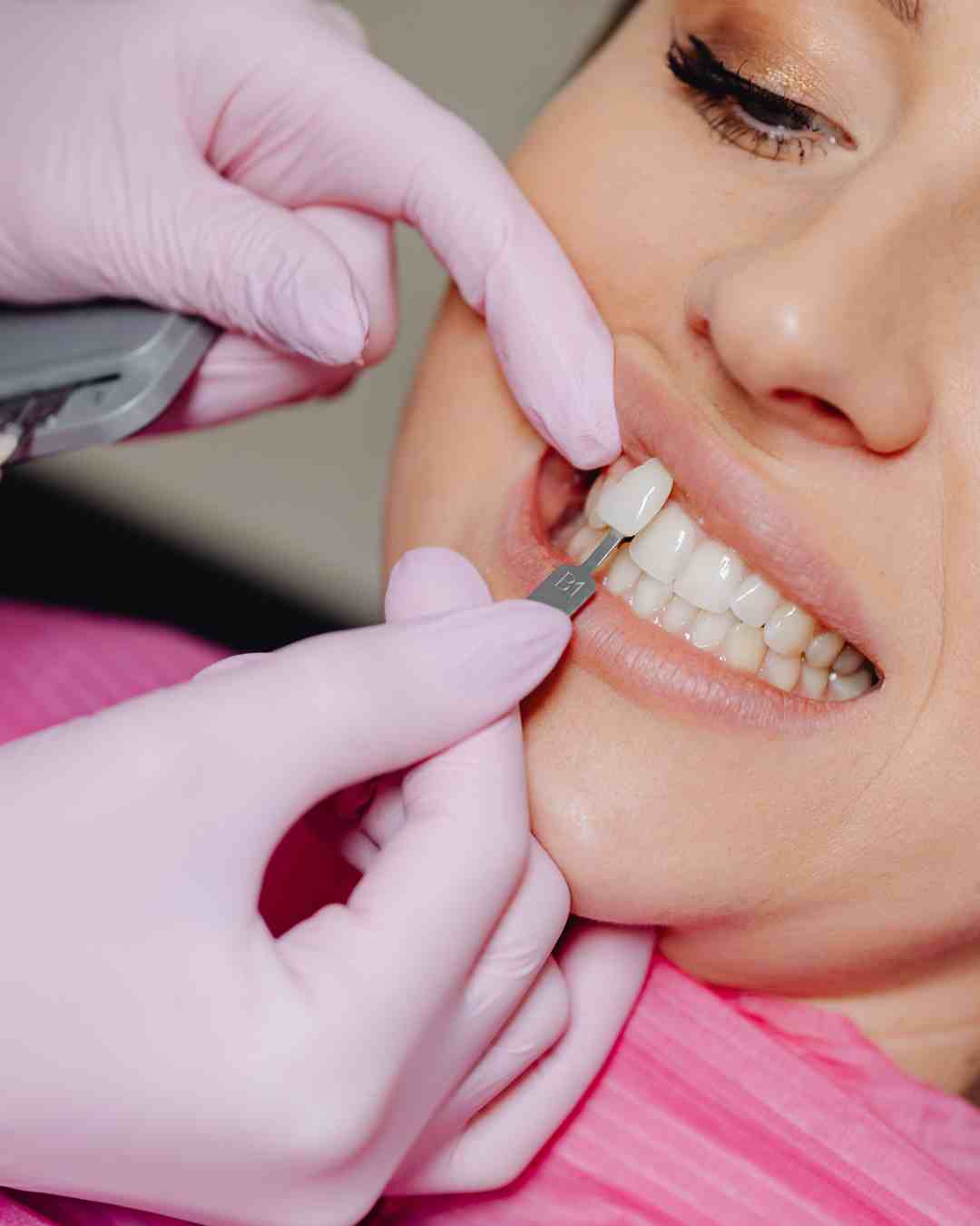 Porcelain Veneers Washington, DC | Smile Makeovers | W Plus Dental