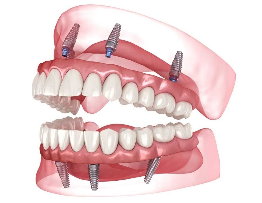 all on x dental implants washington dc