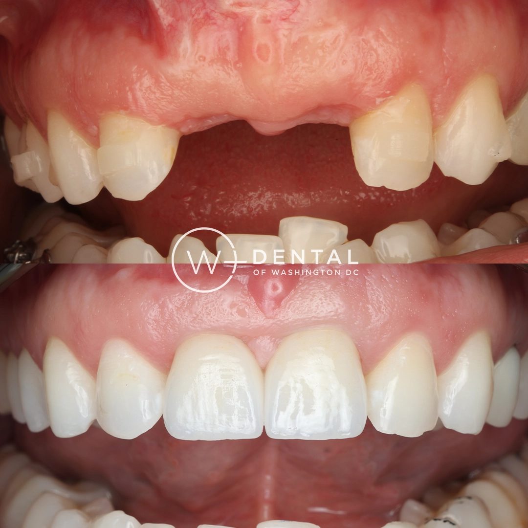 Before and after dental implants at W Plus Dental – patient's smile transformation showing missing tooth replaced with natural-looking implant, Washington DC