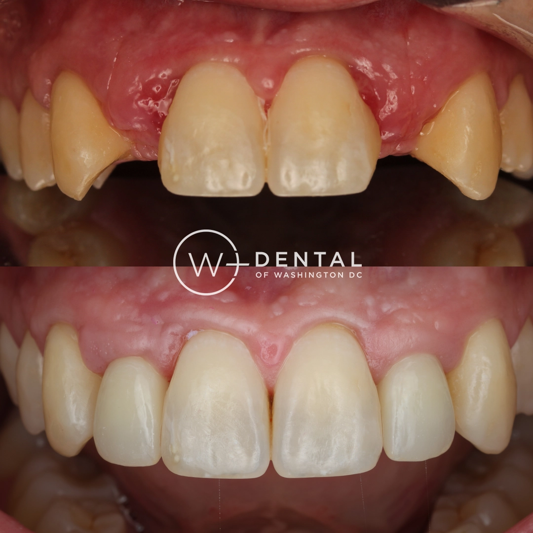 Before and after dental implants at W Plus Dental – patient's smile transformation showing missing tooth replaced with natural-looking implant, Washington DC