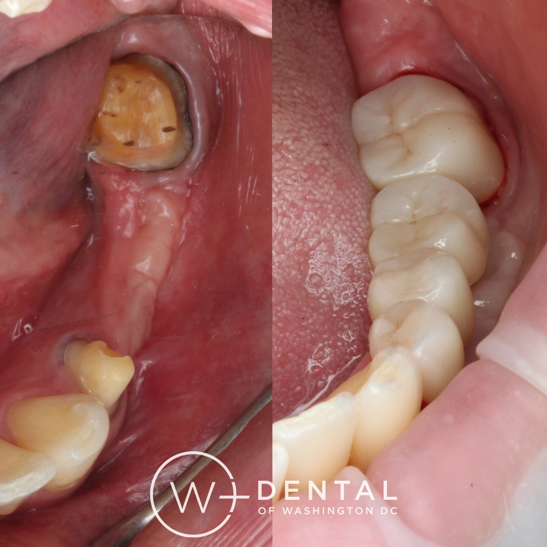 Before and after dental implants at W Plus Dental – patient's smile transformation showing missing tooth replaced with natural-looking implant, Washington DC