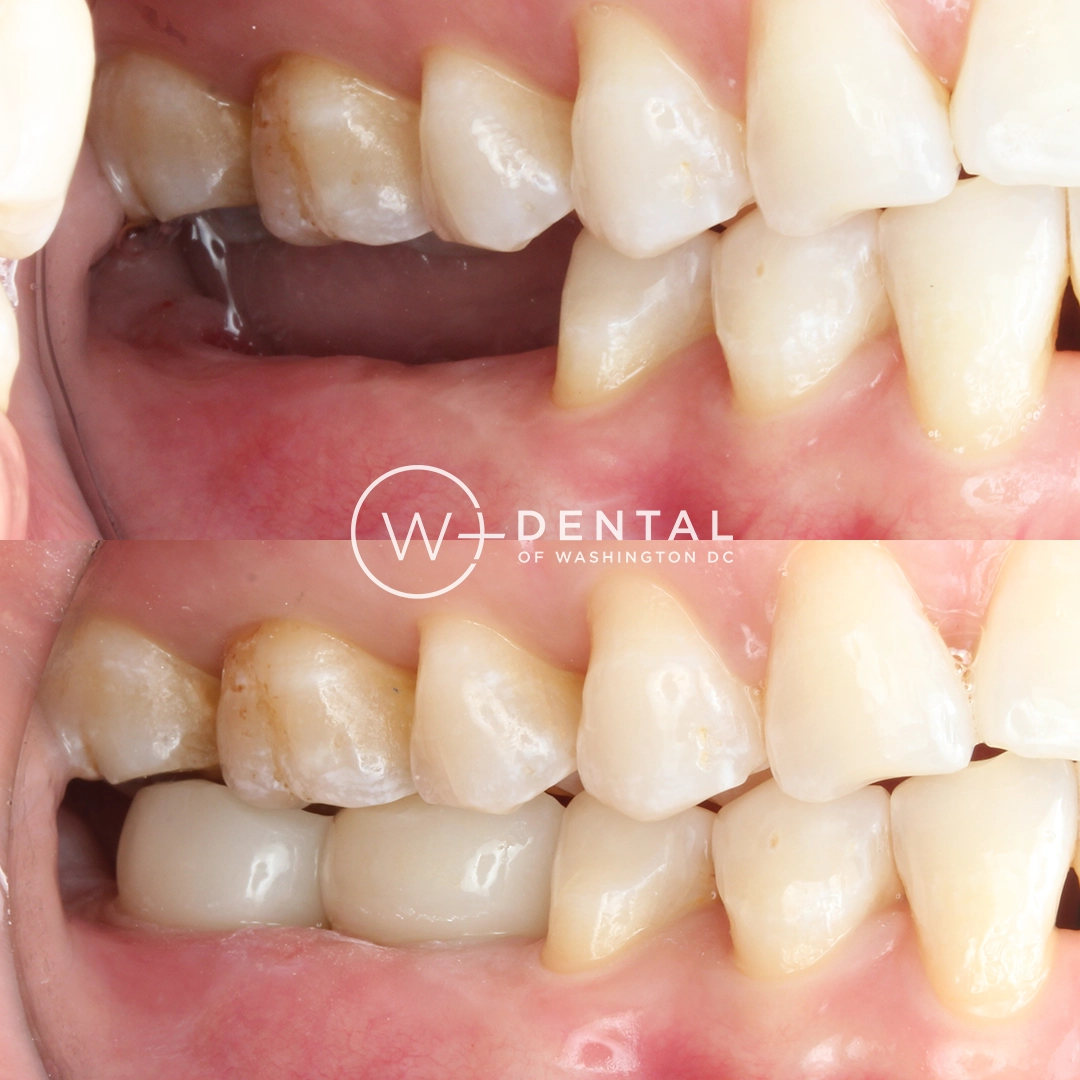 Before and after dental implants at W Plus Dental – patient's smile transformation showing missing tooth replaced with natural-looking implant, Washington DC