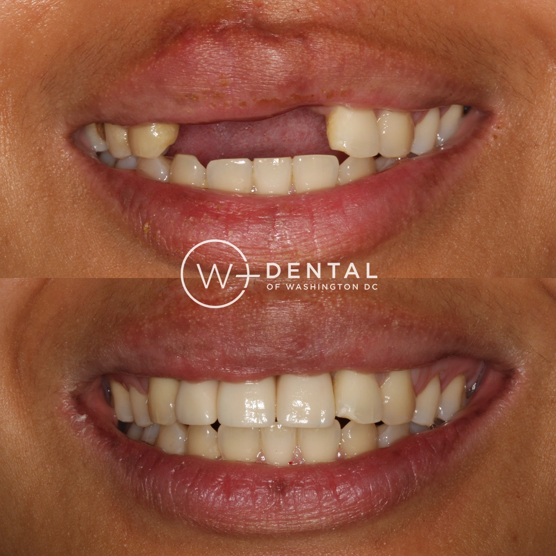 Before and after dental implants at W Plus Dental – patient's smile transformation showing missing tooth replaced with natural-looking implant, Washington DC