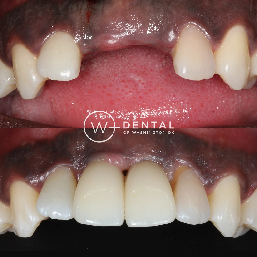 Before and after dental implants at W Plus Dental – patient's smile transformation showing missing tooth replaced with natural-looking implant, Washington DC