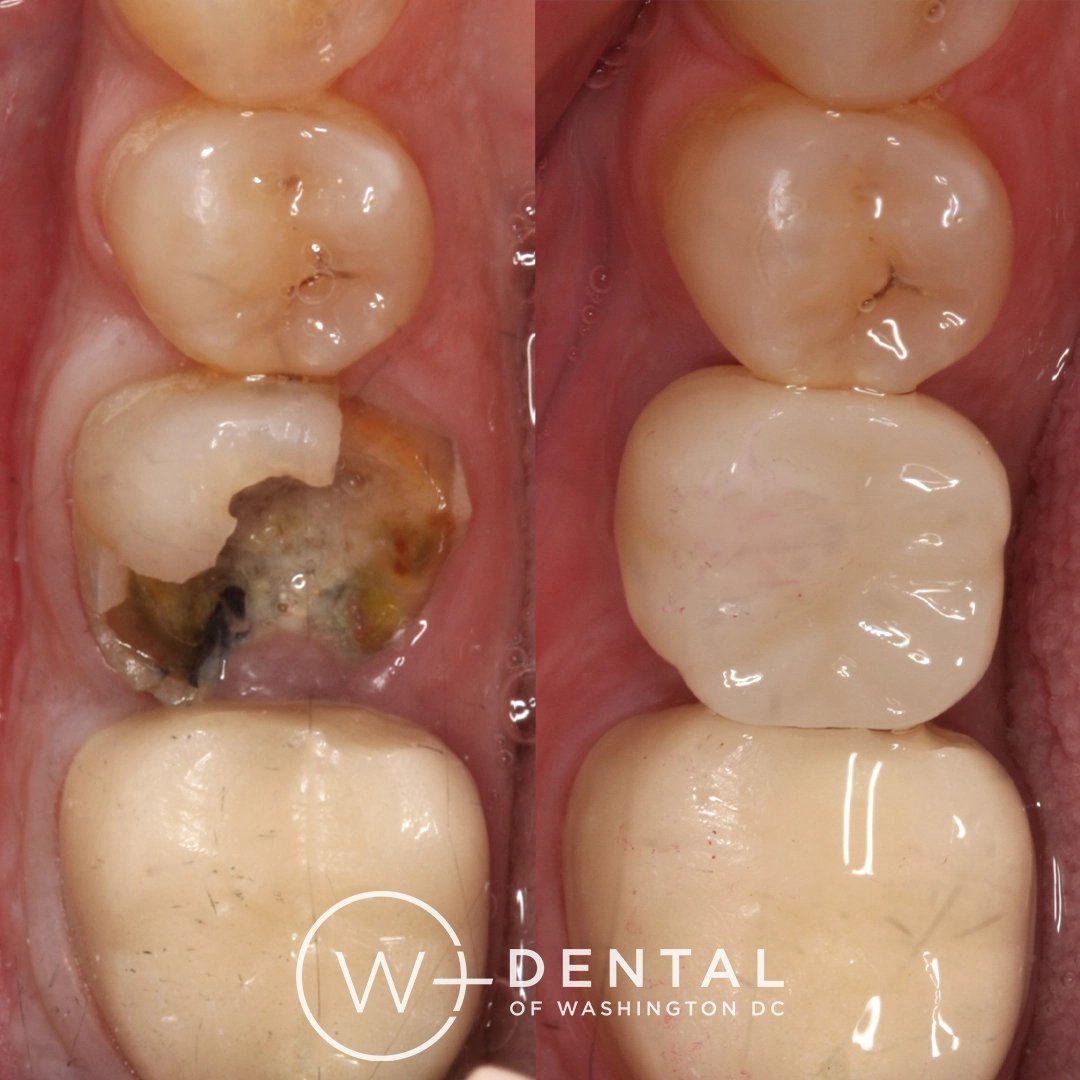 Before and after dental implants at W Plus Dental – patient's smile transformation showing missing tooth replaced with natural-looking implant, Washington DC