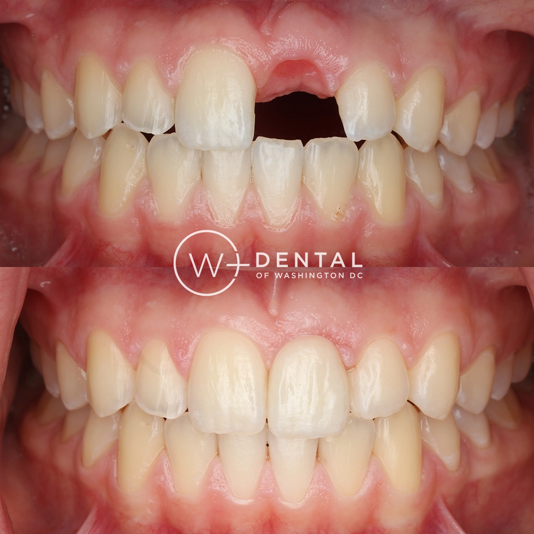 Before and after dental implants at W Plus Dental – patient's smile transformation showing missing tooth replaced with natural-looking implant, Washington DC