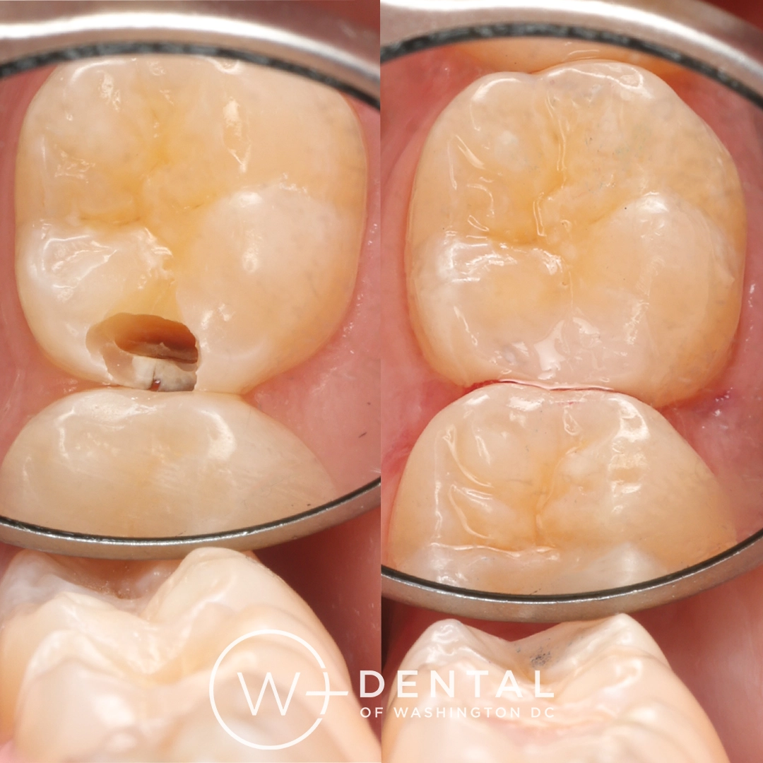 Before and after dental implants at W Plus Dental – patient's smile transformation showing missing tooth replaced with natural-looking implant, Washington DC