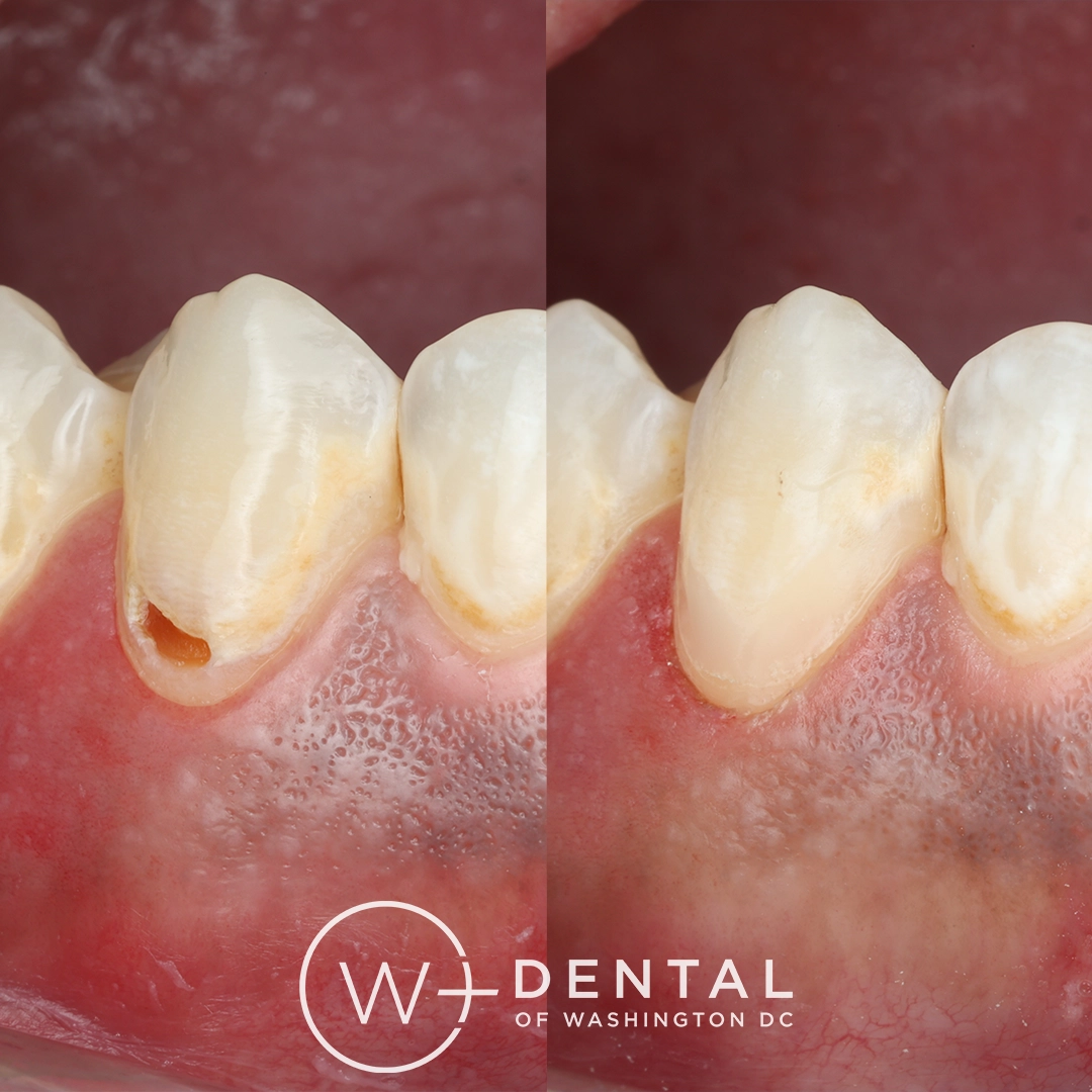 Before and after dental implants at W Plus Dental – patient's smile transformation showing missing tooth replaced with natural-looking implant, Washington DC