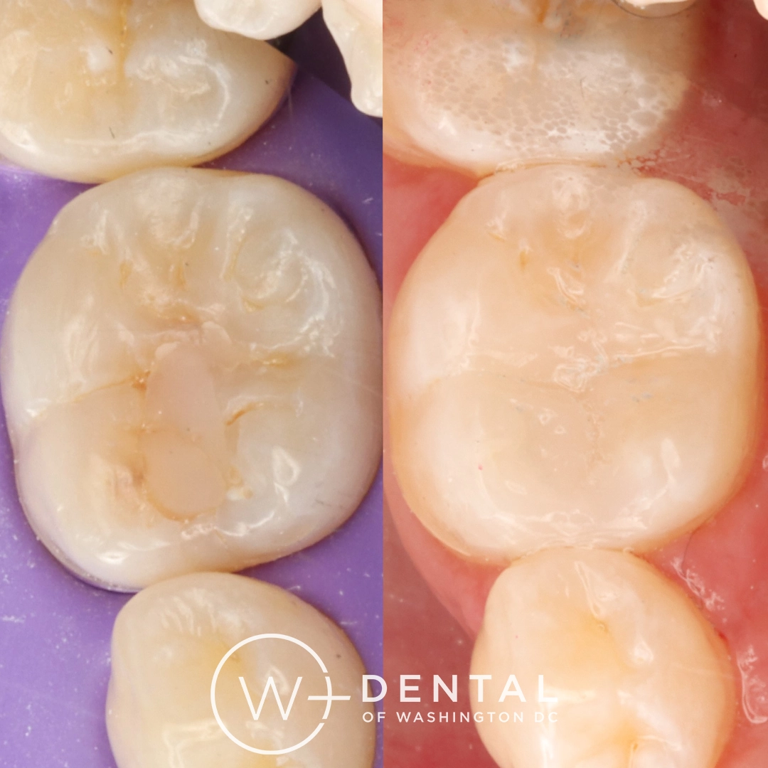 Before and after dental implants at W Plus Dental – patient's smile transformation showing missing tooth replaced with natural-looking implant, Washington DC