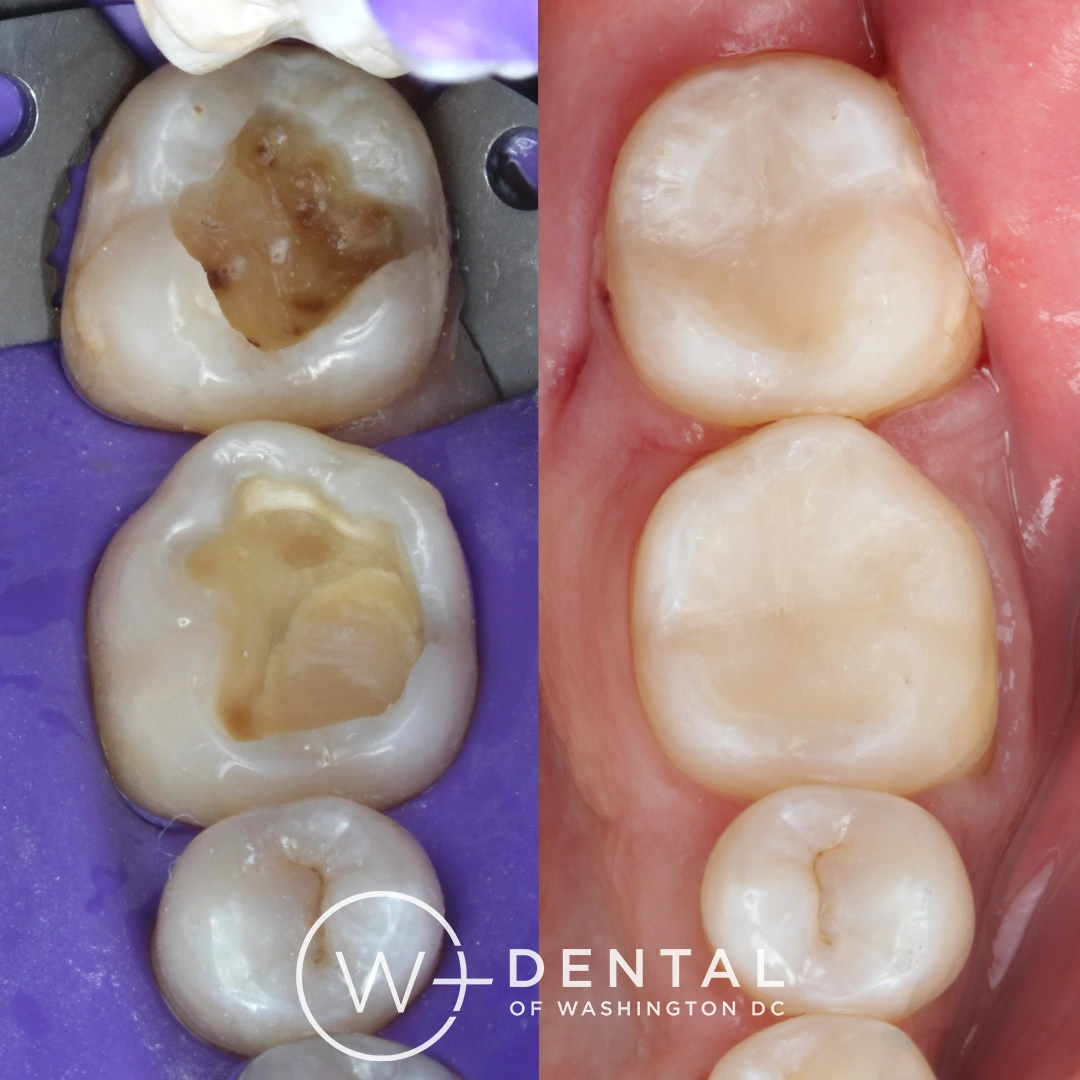 Before and after dental implants at W Plus Dental – patient's smile transformation showing missing tooth replaced with natural-looking implant, Washington DC