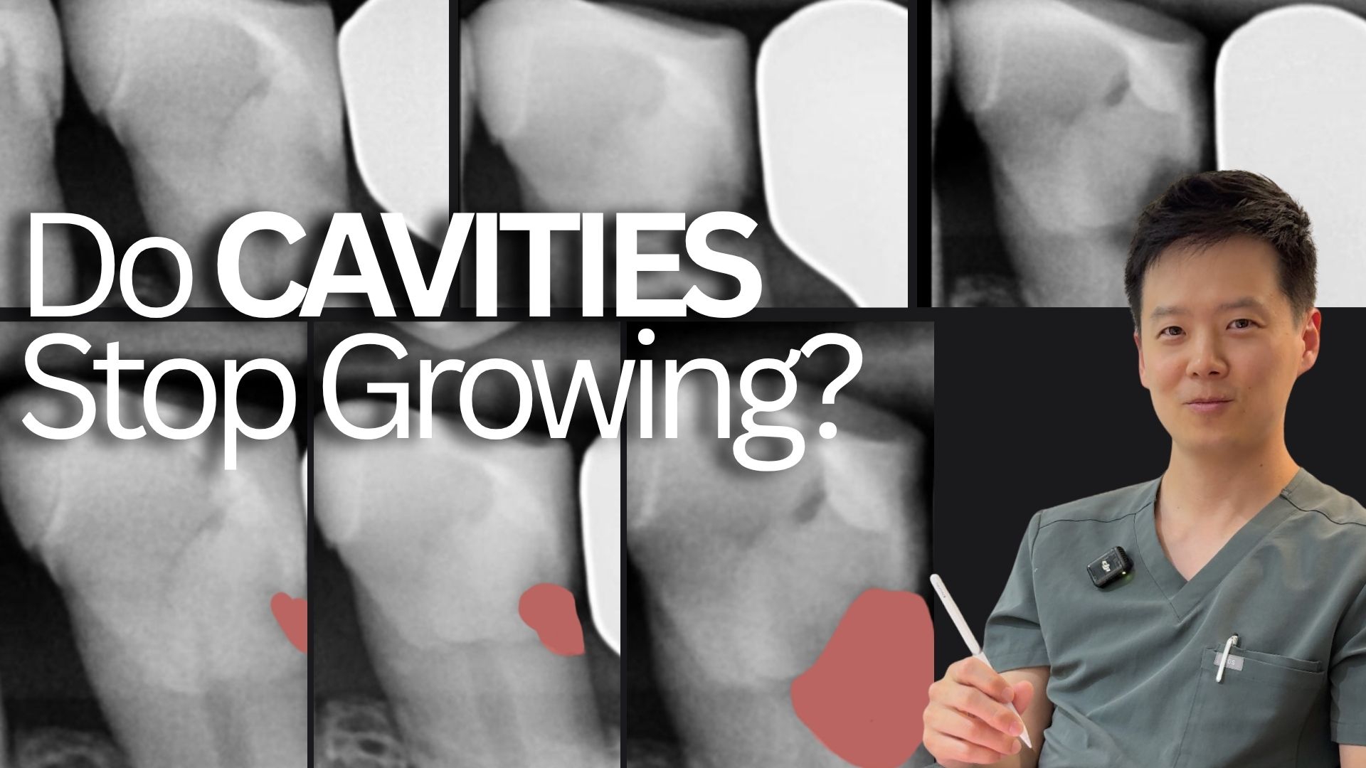 Video of dentist explaining why cavities keep growing