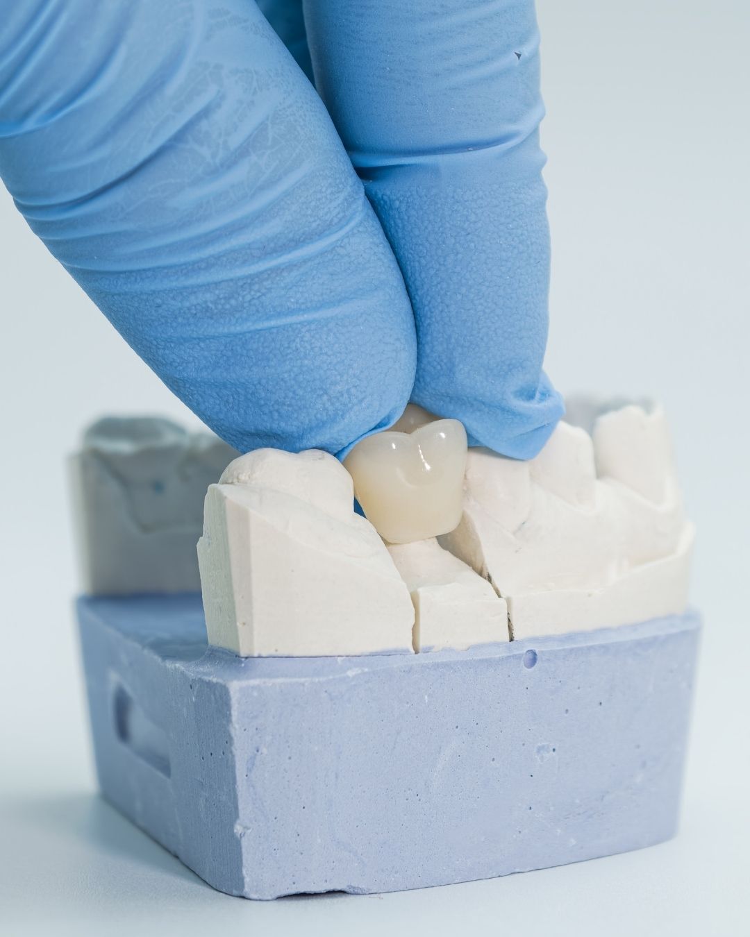 composite filling to blend naturally into the tooth