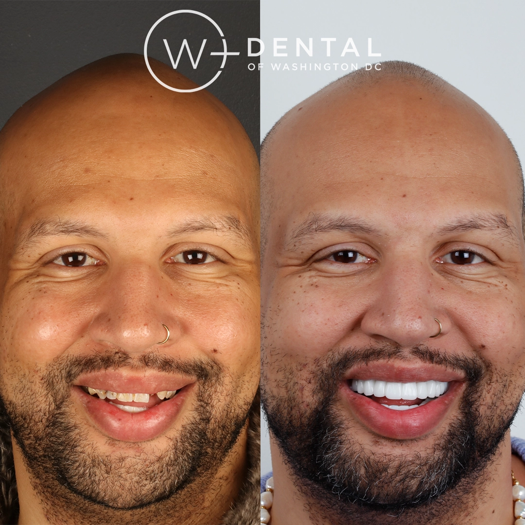 Before and after a smile makeover with All-on-X dental implants at W Plus Dental – full arch tooth replacement transforming missing and failing teeth to a complete, permanent smile, Washington DC