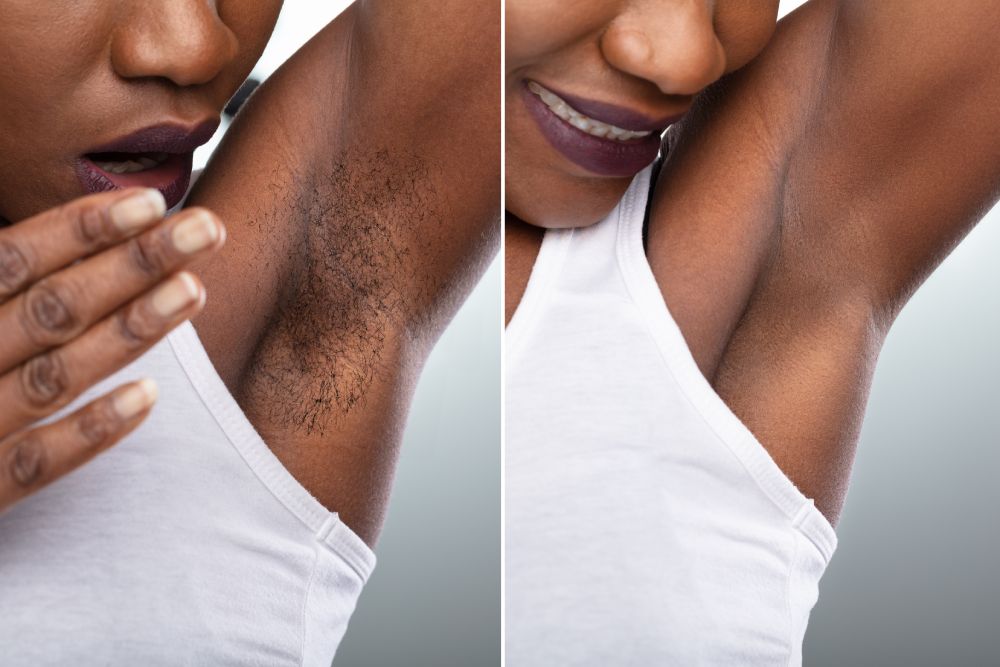 Underarm waxing before and after Miami FL