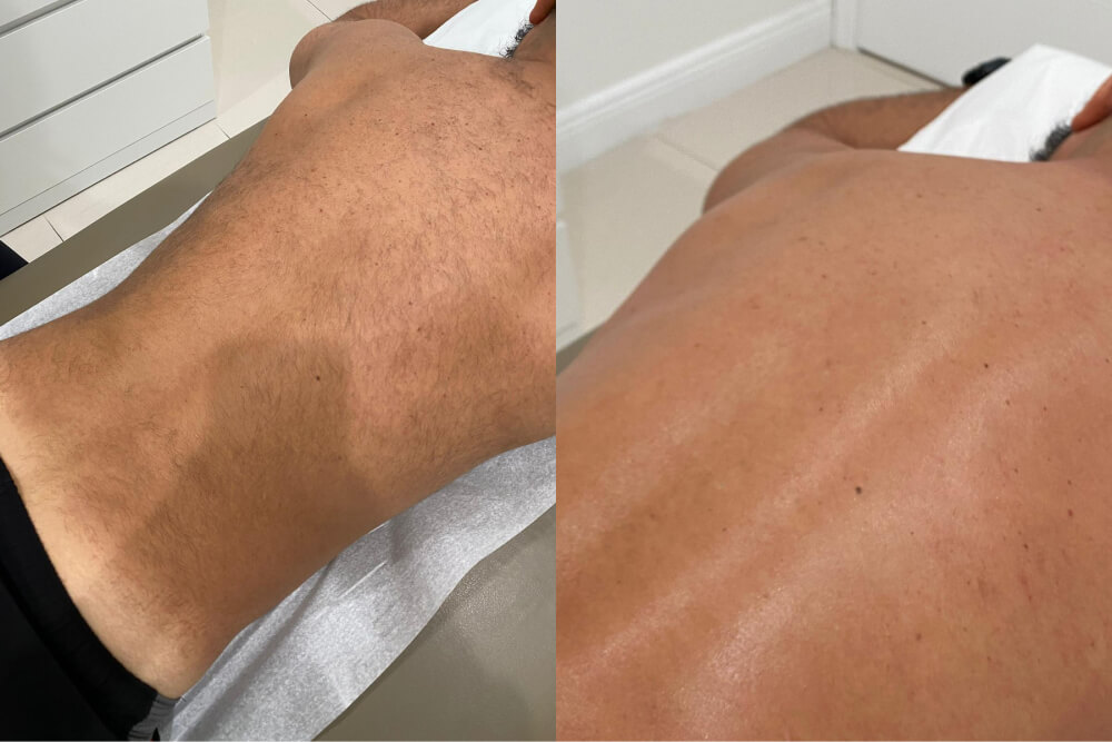 Before and after results of men's back waxing in Miami