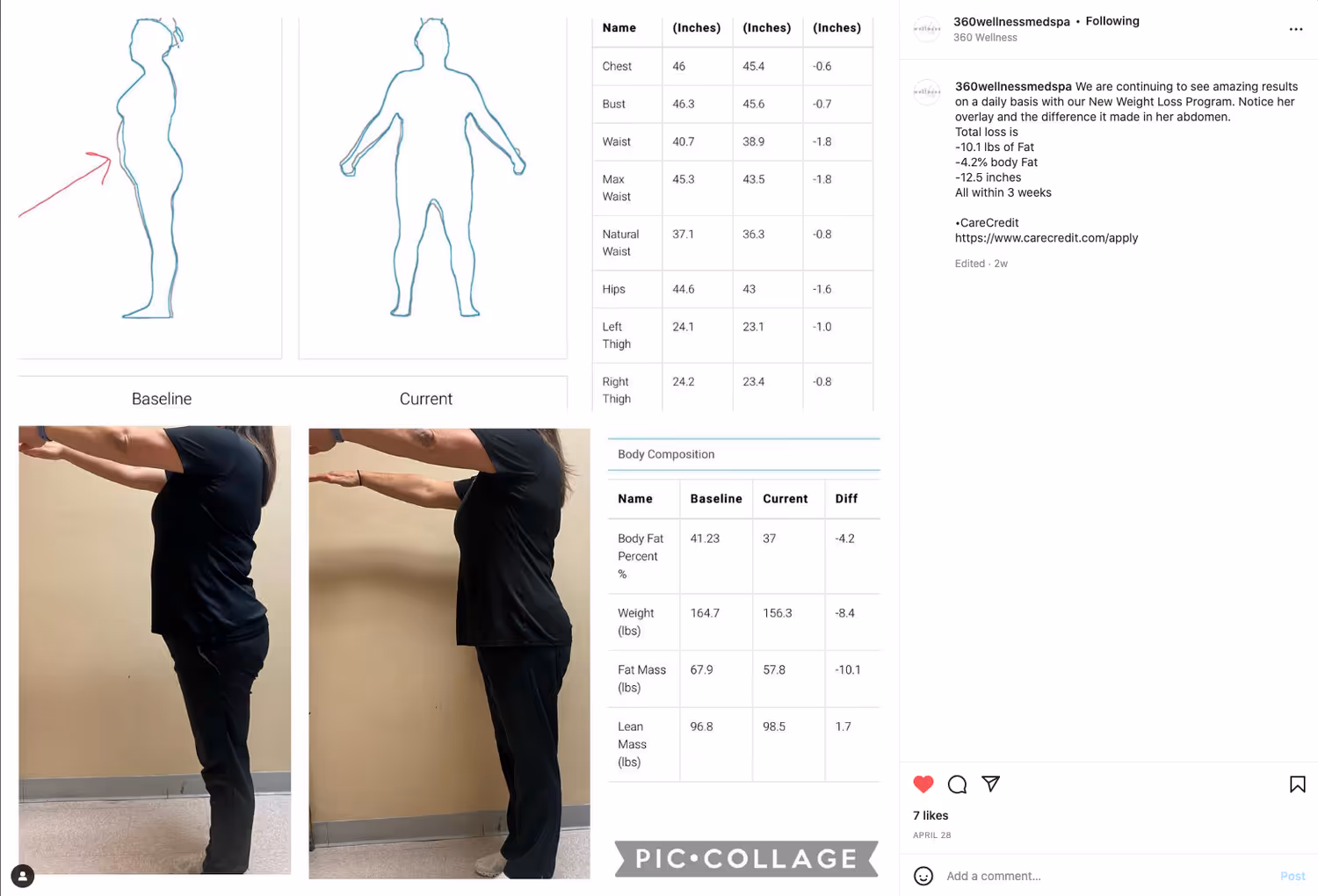 Medical Weight Loss before & after - Semaglutide