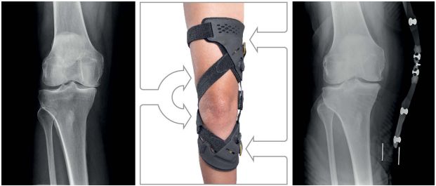 Unloader One X Orthese ÖSSUR Deutschland GmbH