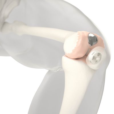 Kniegelenk mit einem individuellen eingebrachten patelloformalen Implantat der Firma Episurf