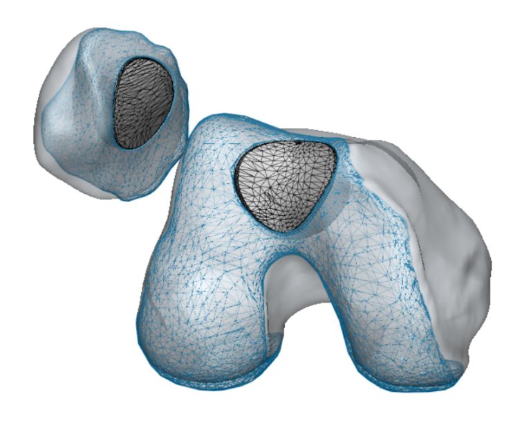 3D-Rekonstruktion eines Kniegelenks, die grau-schwarze Fläche zeit sich betroffene Region bei einer patellfemoralen Gonarthrose
