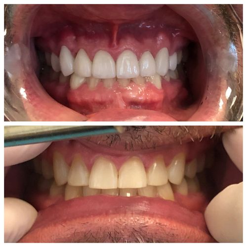 before and after treatment