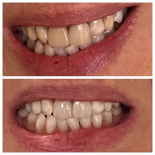 before and after treatment