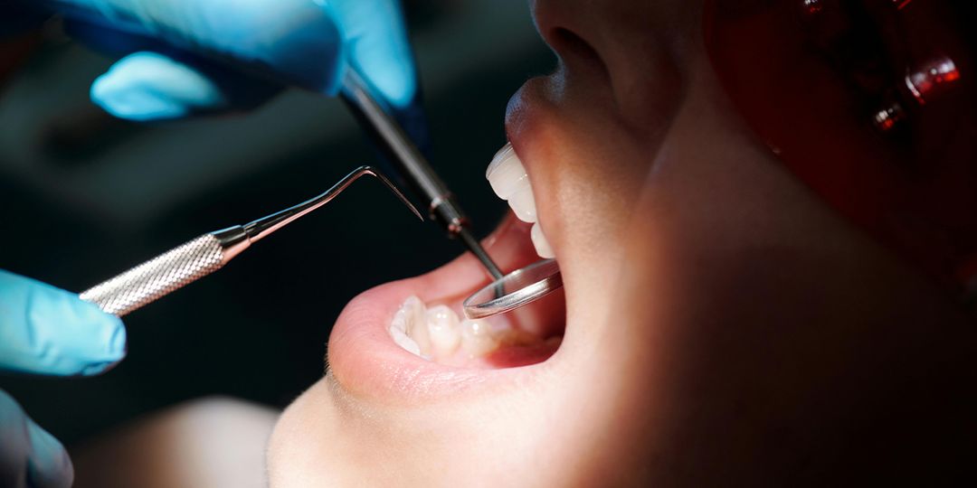 Tooth Extractin Understanding Teeth Extraction: What You Need to Know
