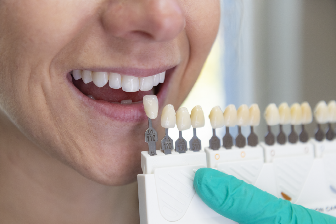 Holiday Smile Ready? Let’s Talk Teeth Whitening